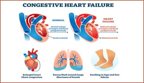 Heart Failure And The Plight Of Extreme Obesity
